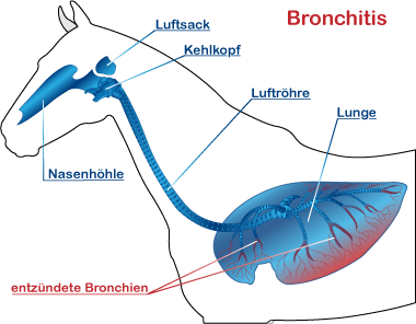 Bronchitis